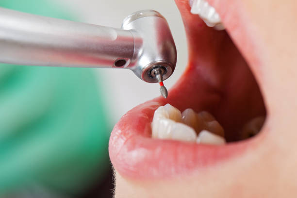 Best Lost Filling or Crown Replacement in Aberdeen, ID